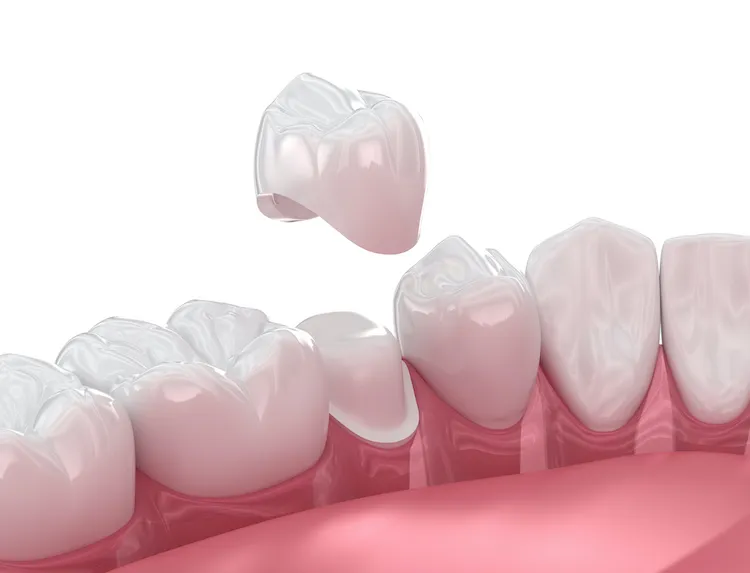 Can Dental Crowns Fix More? in Greensboro, NC