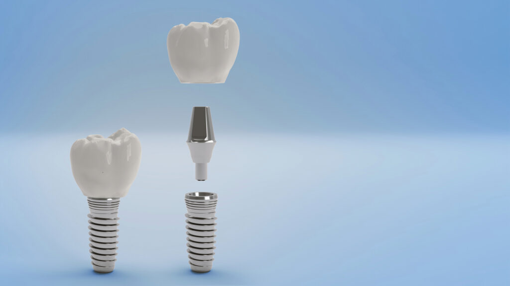 Tooth Implant Greensboro NC