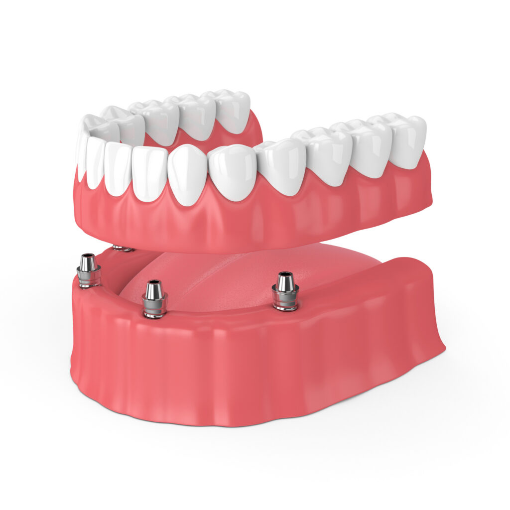 Implant Dentures Greensboro NC