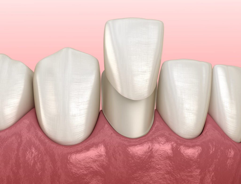 Dental Veneers in Greensboro NC